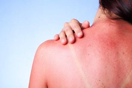 How Long Should a Sunburn Last